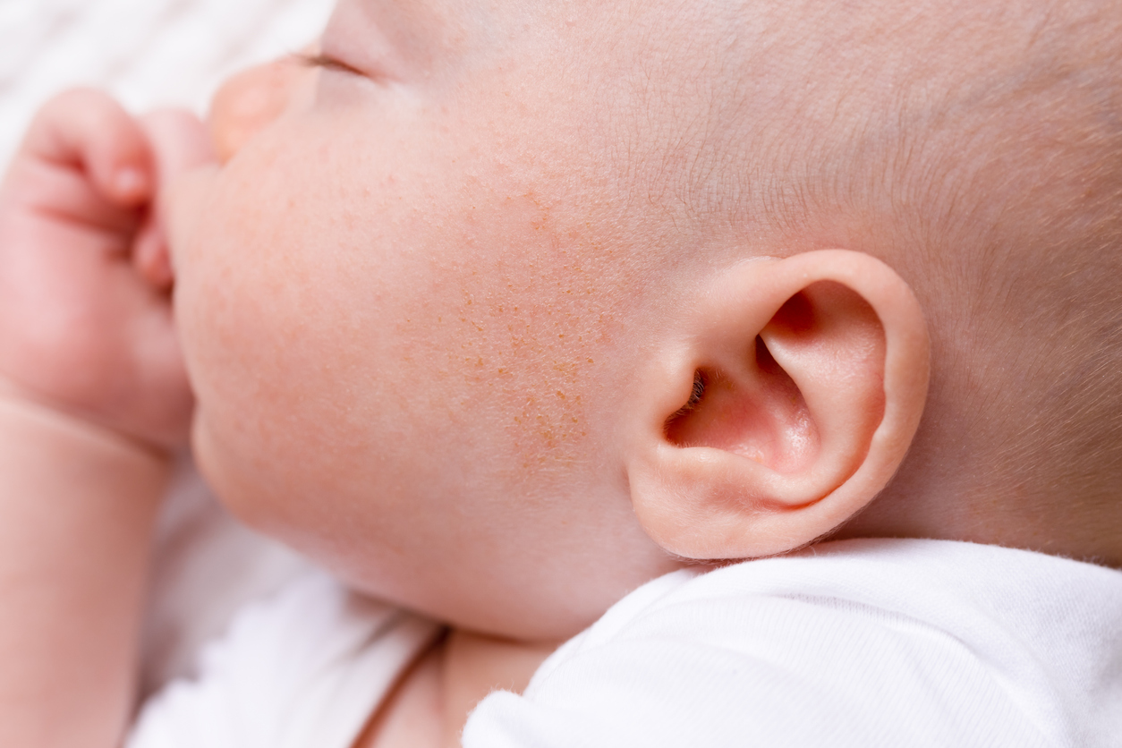 alergias en bebes en cara